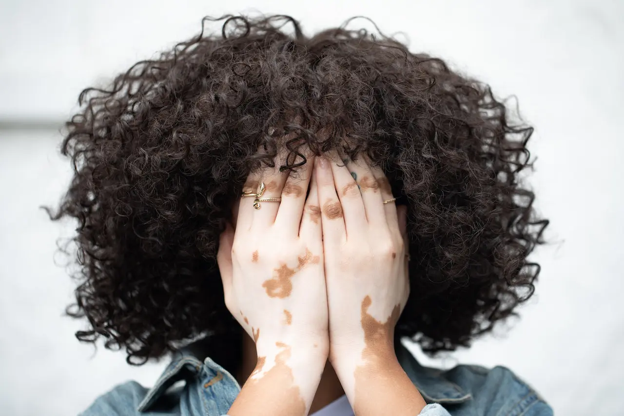 Vitiligo | black female therapy in Atlanta | black female therapists near me | therapy for women of color in Atlanta, GA | 30135 | 30004 | 30034 Image of a woman of color covering her face. Showing the importance of getting support from black female therapy in Atlanta. If you want to empbrace your authentic self then therapy for women of color with a black female therapist in Atlanta, GA can help!